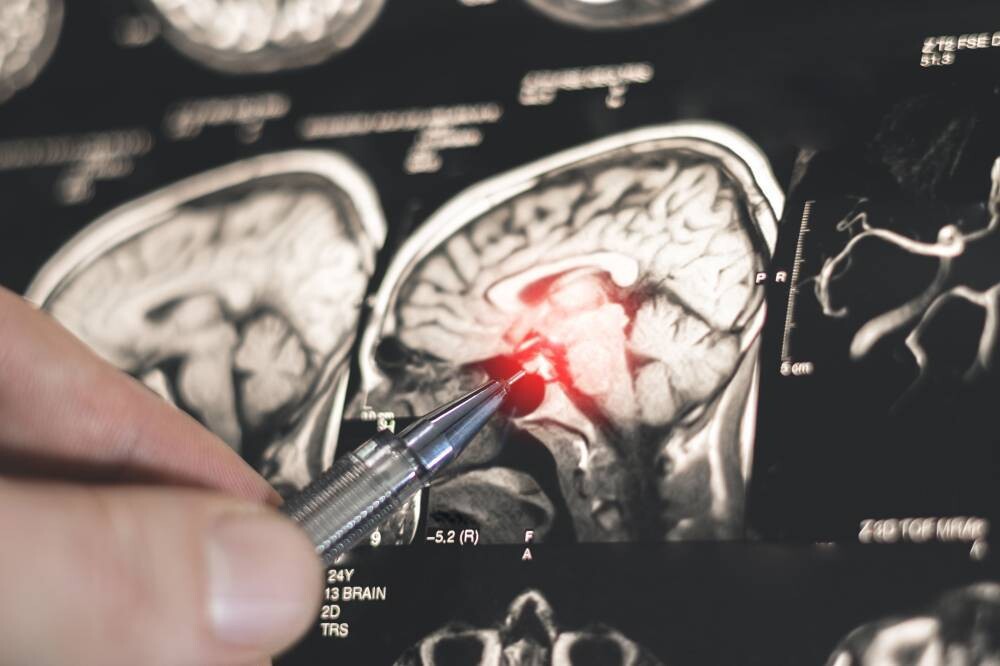 Russian Researchers Discover Role of CRYAB Protein in Diabetes