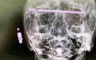 Удивительное открытие: в голове 78-летнего человека найден гвоздь